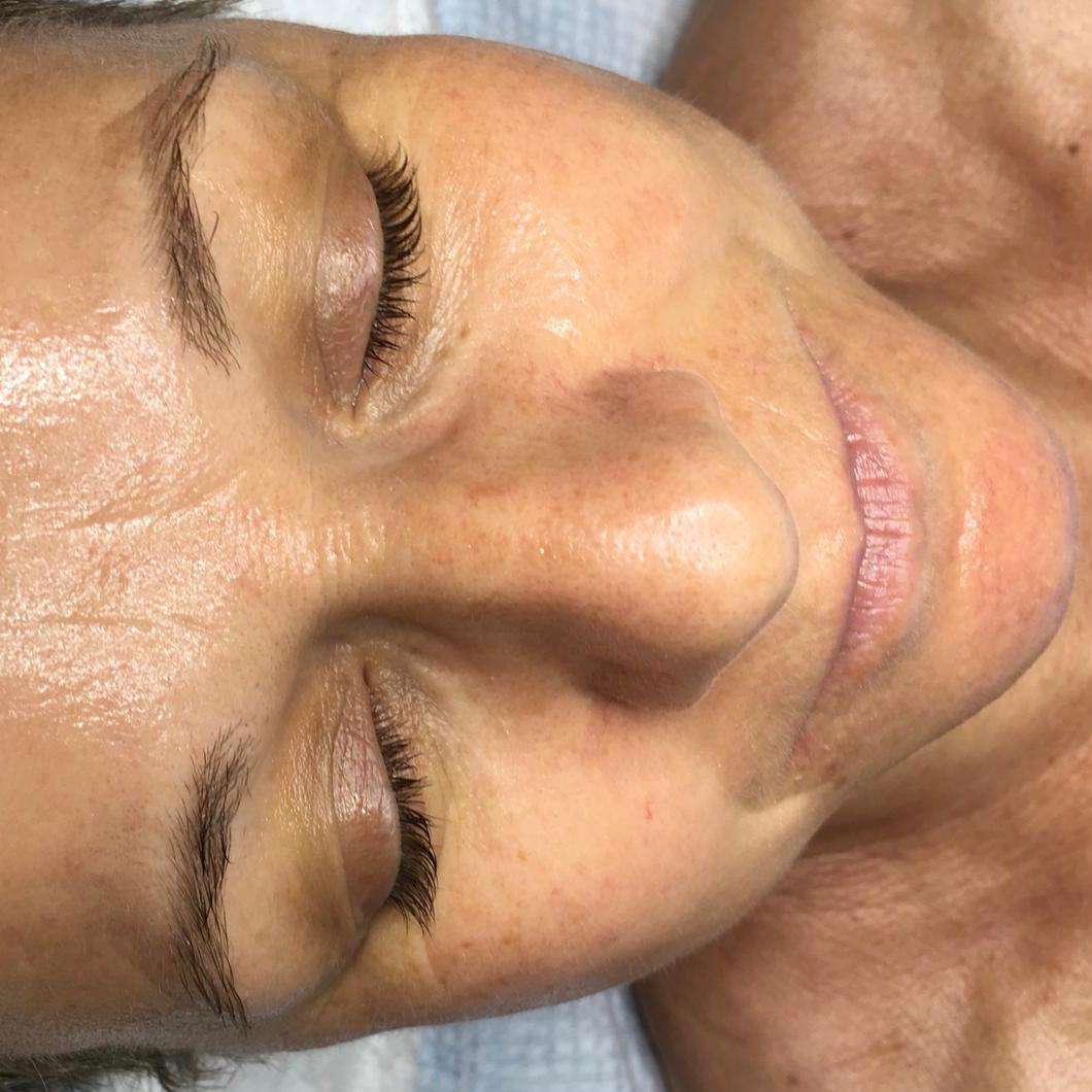 Jetpeel Haut nacher Jetpeel Haut nacher