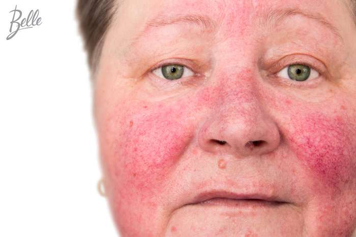 Couperose Rosacea