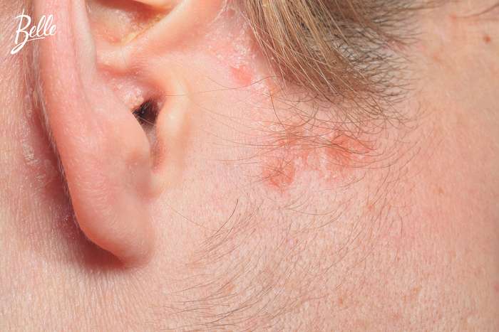 Psoriasis Schuppenflechte