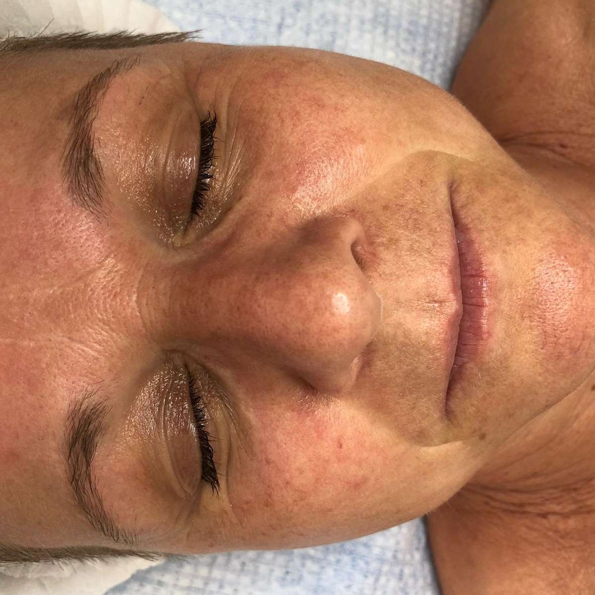 Jetpeel Haut vorher Jetpeel Haut vorher